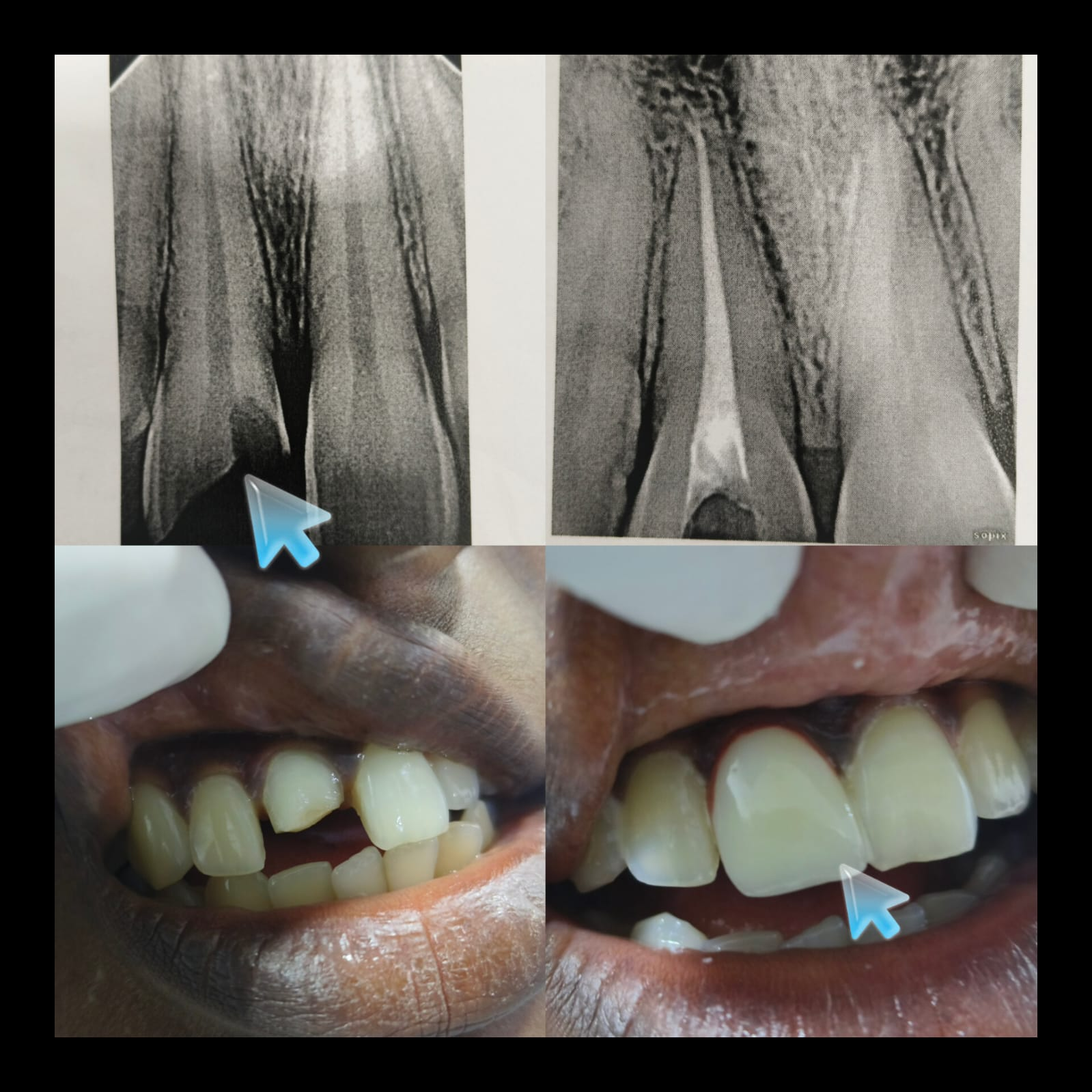 Root canal, then a rebuilt front tooth