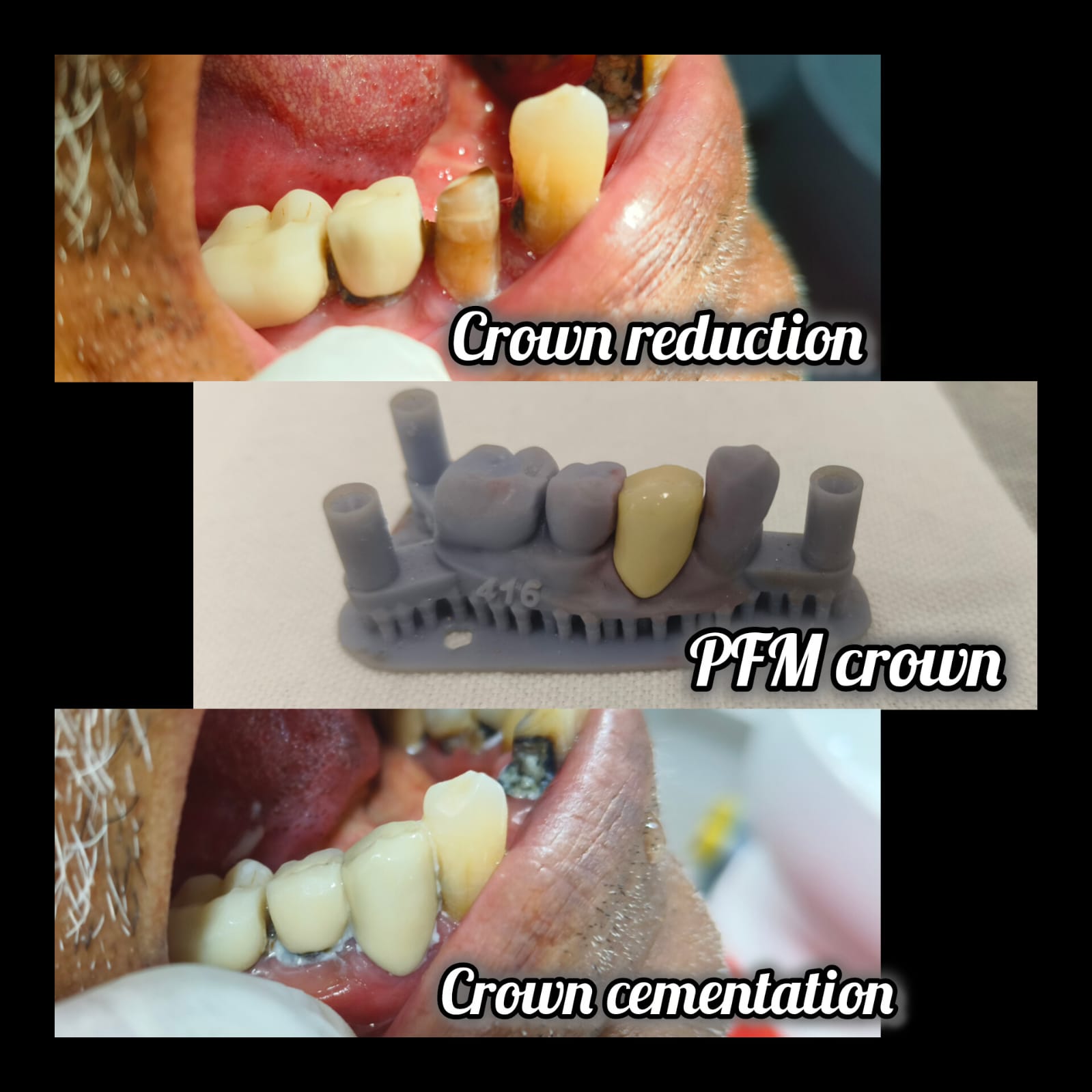 Crown, start to finish