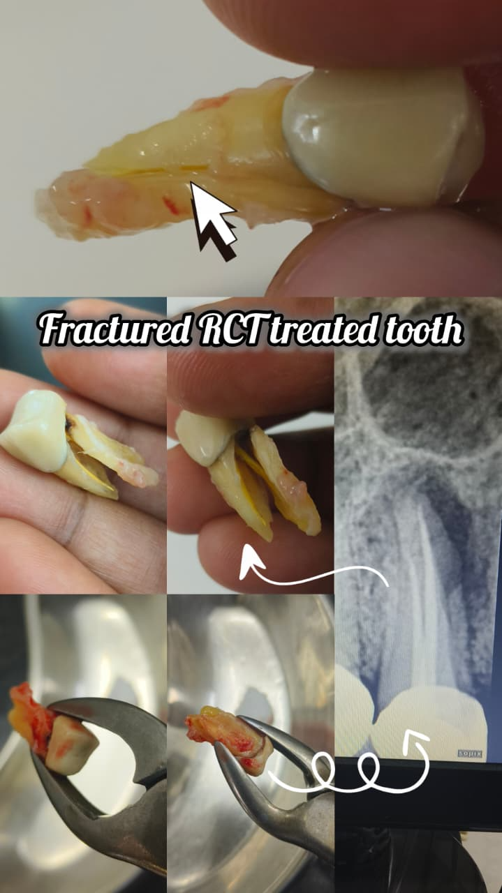 A fractured root-treated tooth