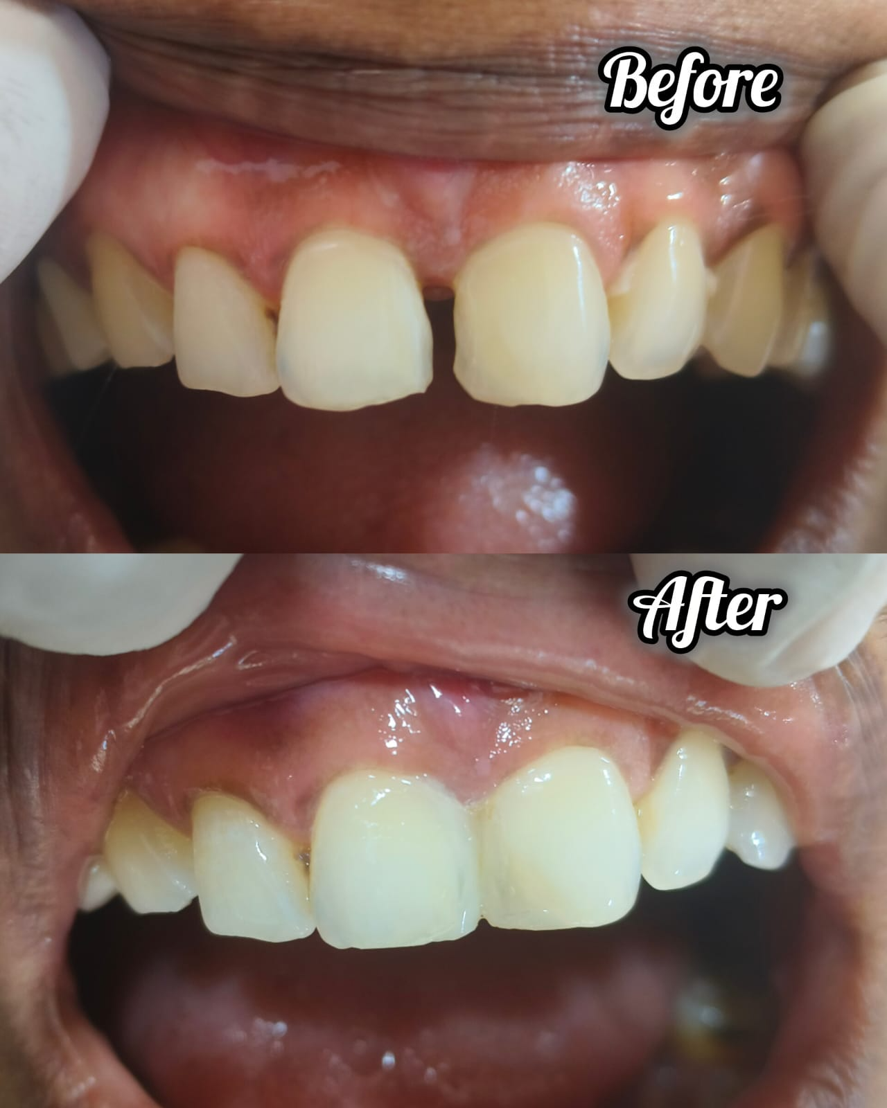 Front gap closed in one sitting