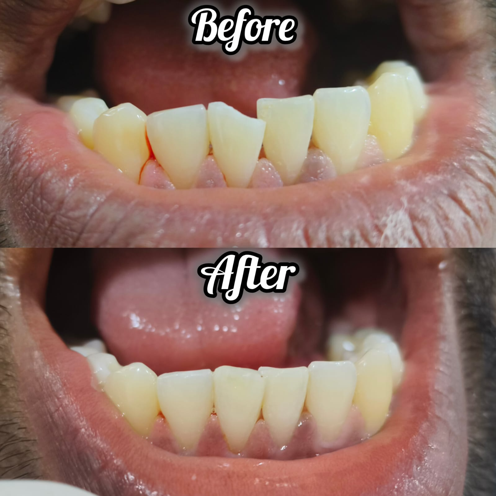 Gums settled after cleaning