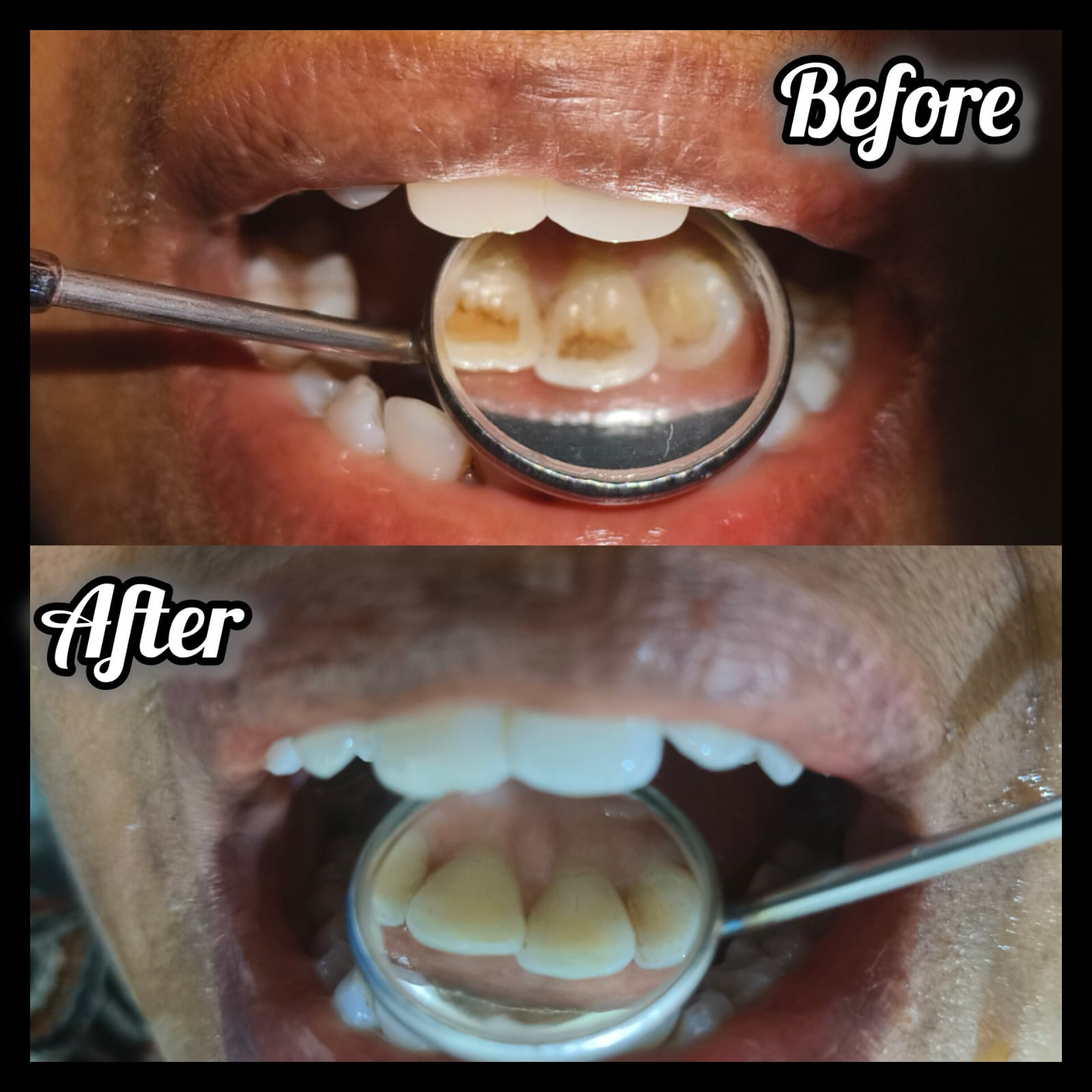 Decay cleared, teeth rebuilt